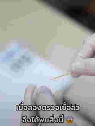 ตรวจเชื้อสิว