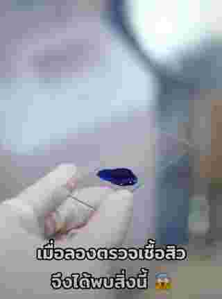 ตรวจเชื้อสิว
