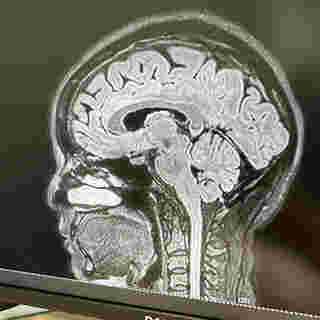 MRI สมอง
