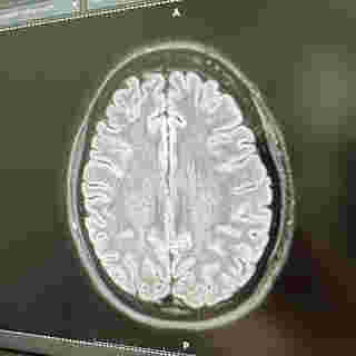 MRI สมอง