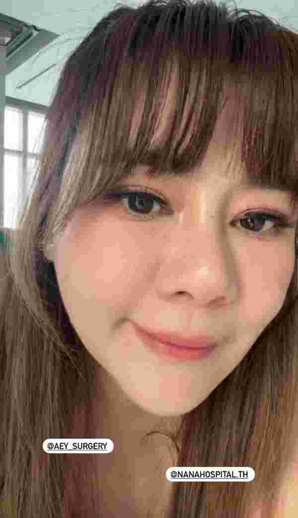 โอ๋ ภัคจีรา ศัลยกรรม