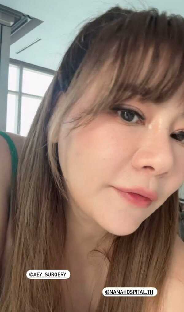 โอ๋ ภัคจีรา ศัลยกรรม